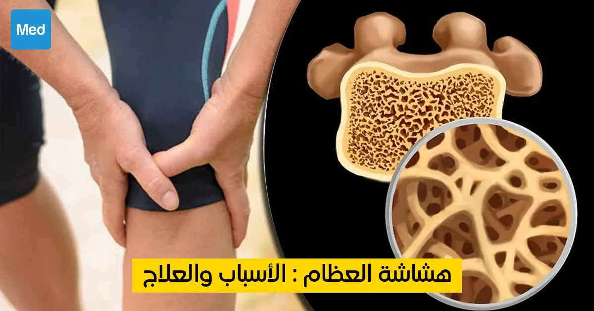 هشاشة العظام: الأسباب والعلاج